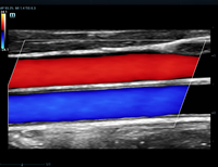carotid cca and jugular color