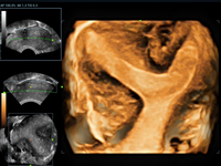 uterus septus